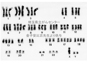 神経芽腫の3N腫瘍の染色体分析